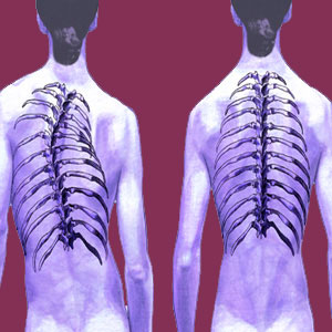 C Curve Scoliosis