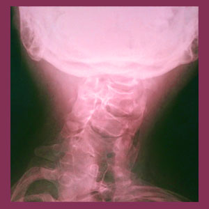Cervical scoliosis
