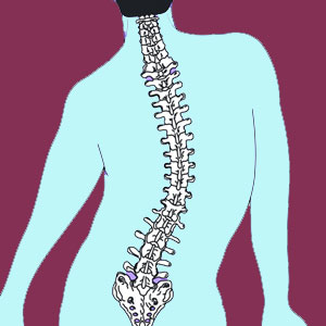 Cervicothoracic Scoliosis