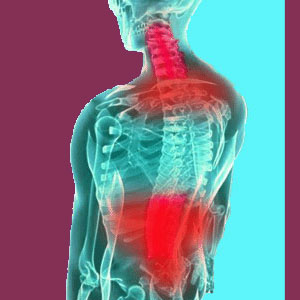 Cervicothoracolumbar scoliosis