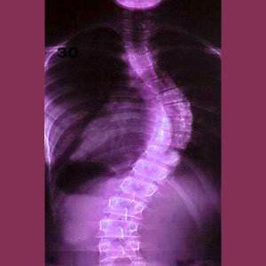 Congenital scoliosis