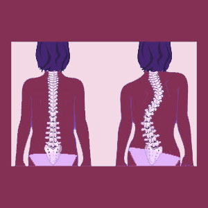 Double Scoliosis