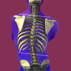 Fixed Scoliosis