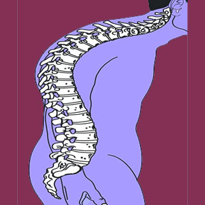 Idiopathic scoliosis