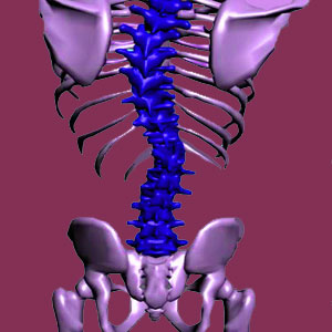 Infantile scoliosis