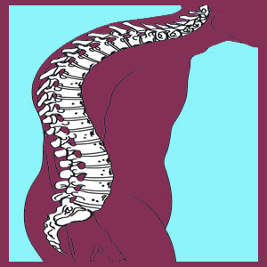 Neuromuscular scoliosis