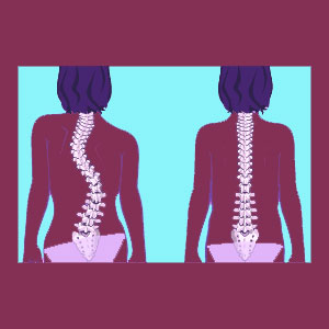 S curve scoliosis