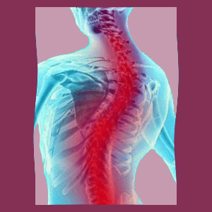 Scoliosis Affecting Heart