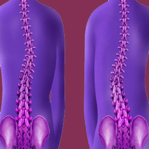 Scoliosis Diagnosis