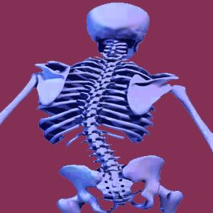 Scoliosis Explanation