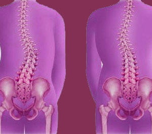 scoliosis facts