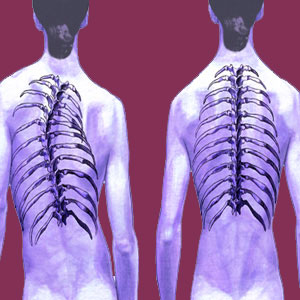 scoliosis from spina bifida