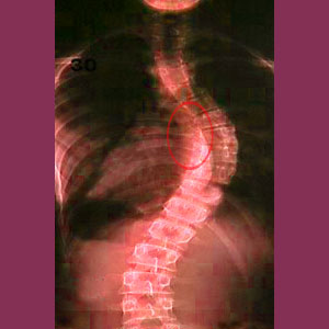 Scoliosis neuroforaminal stenosis