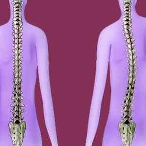 Scoliosis Scapegoat