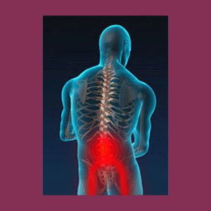 Scoliosis Sciatica