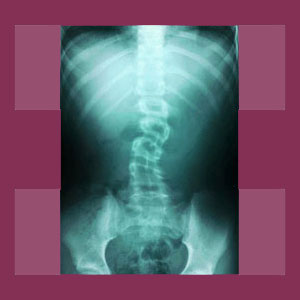 Scoliosis x-ray