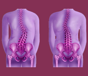 Side to Side Spinal Curvature