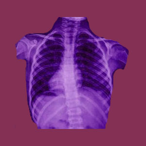 Spinal stenosis from scoliosis