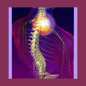 Tension Myositis Syndrome Scoliosis