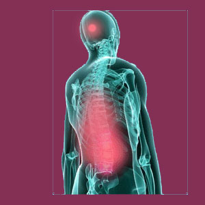 Thoracolumbar scoliosis