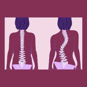 Why Does Scoliosis Progress in Girls?